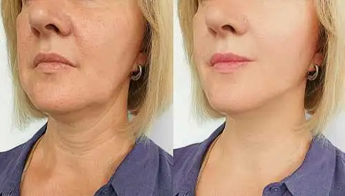 Fillers and Where Can You Get Lip Fillers